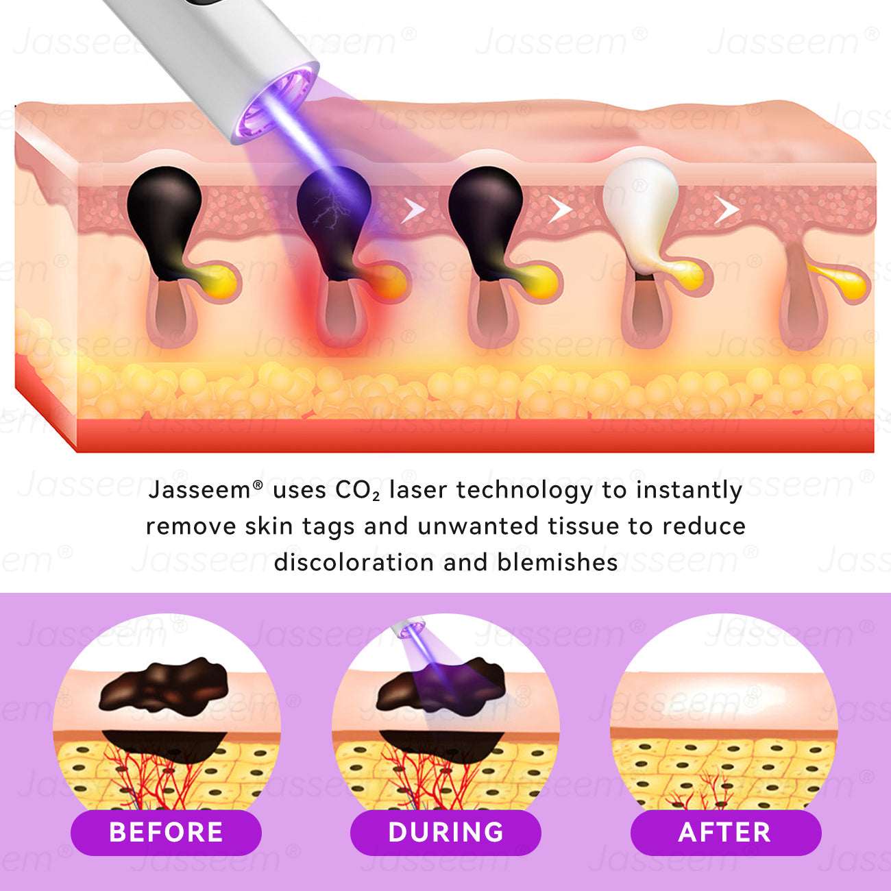 𝐉𝐚𝐬𝐬𝐞𝐞𝐦®👩⚕️Pokročilé neinvazívne CO₂ laserové pero na opravu pokožky – (Jemne odstraňuje bradavice, materské znamienka, starecké škvrny a kožné výrastky – bezbolestne a bez starostí!)💕