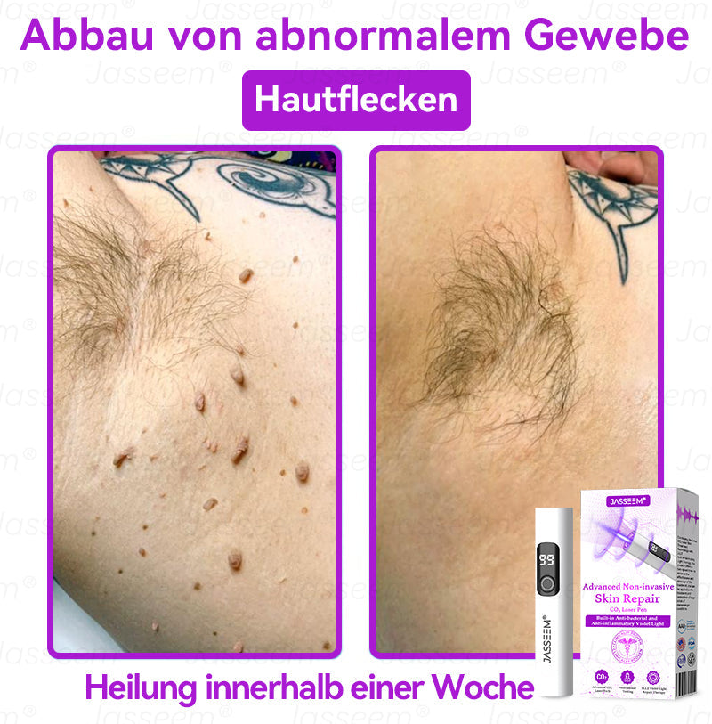 𝐉𝐚𝐬𝐬𝐞𝐞𝐦®👩⚕️Pokročilé neinvazívne CO₂ laserové pero na opravu pokožky – (Jemne odstraňuje bradavice, materské znamienka, starecké škvrny a kožné výrastky – bezbolestne a bez starostí!)💕