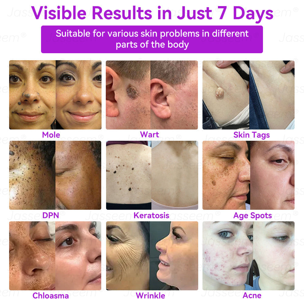 𝐉𝐚𝐬𝐬𝐞𝐞𝐦®👩⚕️Pokročilé neinvazívne CO₂ laserové pero na opravu pokožky – (Jemne odstraňuje bradavice, materské znamienka, starecké škvrny a kožné výrastky – bezbolestne a bez starostí!)💕