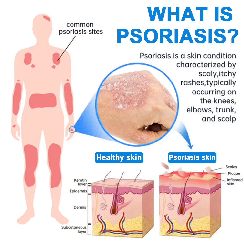 Oficiálny obchod: Zvoevo® 👩⚕️ Horčíkový bylinný sprej proti psoriáze — Schválené FDA (Uľavuje od psoriázy a ekzému, zlepšuje bakteriálne infekcie v genitálnej oblasti, lieči rosaceu a hidradenitídu suppurativu, ako aj akné a bradavice) 🔥