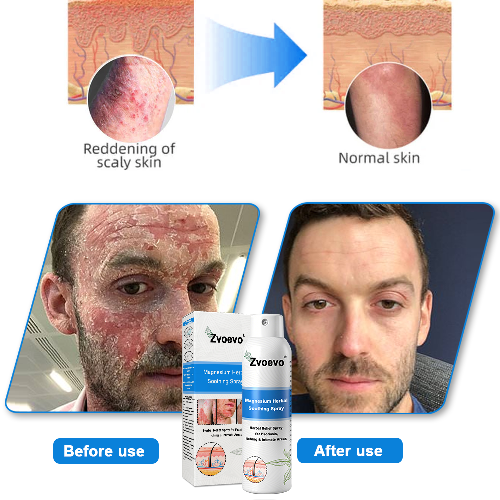 Oficiálny obchod: Zvoevo® 👩⚕️ Horčíkový bylinný sprej proti psoriáze — Schválené FDA (Uľavuje od psoriázy a ekzému, zlepšuje bakteriálne infekcie v genitálnej oblasti, lieči rosaceu a hidradenitídu suppurativu, ako aj akné a bradavice) 🔥