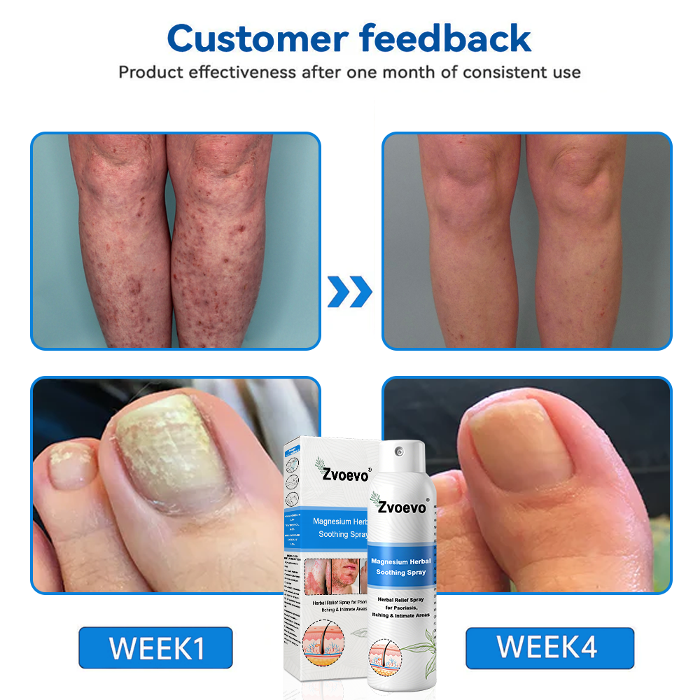 Oficiálny obchod: Zvoevo® 👩⚕️ Horčíkový bylinný sprej proti psoriáze — Schválené FDA (Uľavuje od psoriázy a ekzému, zlepšuje bakteriálne infekcie v genitálnej oblasti, lieči rosaceu a hidradenitídu suppurativu, ako aj akné a bradavice) 🔥