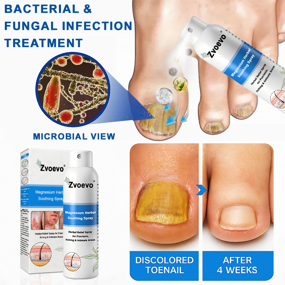 Oficiálny obchod: Zvoevo® 👩⚕️ Horčíkový bylinný sprej proti psoriáze — Schválené FDA (Uľavuje od psoriázy a ekzému, zlepšuje bakteriálne infekcie v genitálnej oblasti, lieči rosaceu a hidradenitídu suppurativu, ako aj akné a bradavice) 🔥