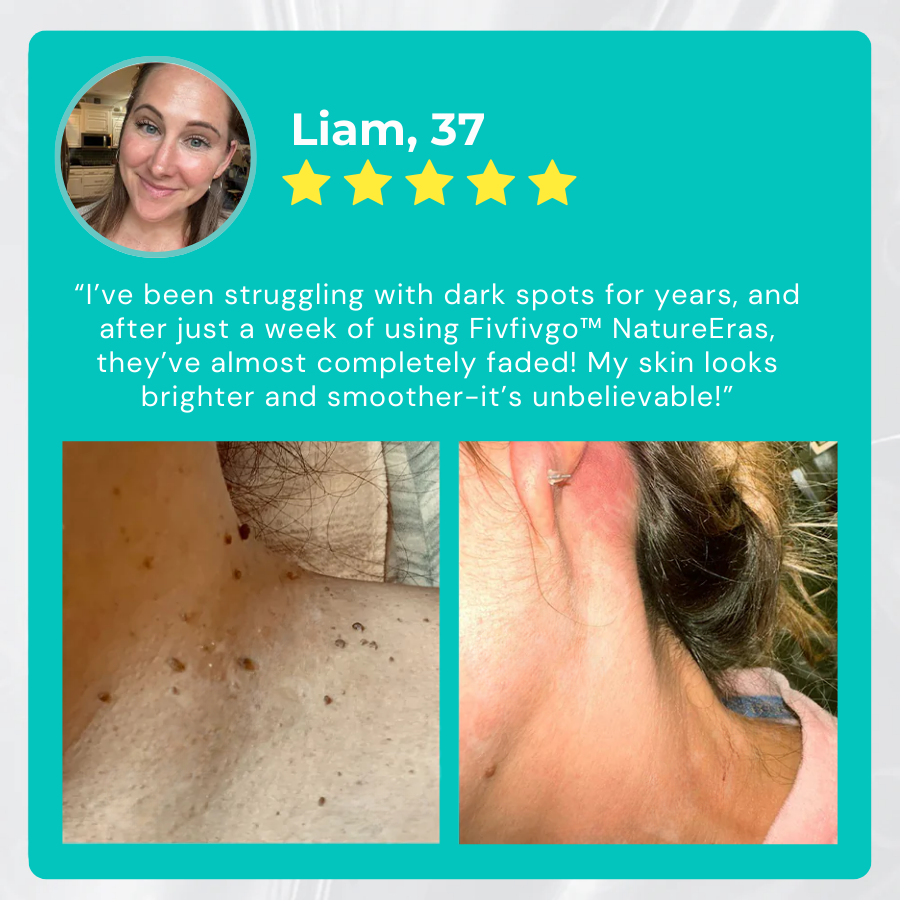 Fivfivgo™ 👩⚕️NatureErase Instant Krém na Pieprzyky a Škvrny – Prírodné zložky presne ošetrujú, zanechávajú pokožku hladkú, rovnomernú a žiarivú 🔅