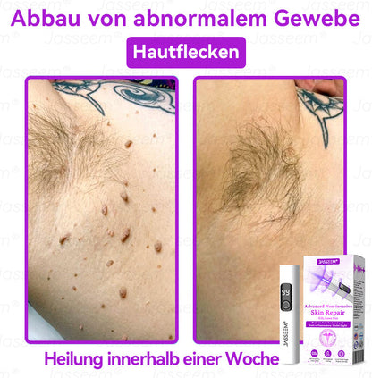 𝐉𝐚𝐬𝐬𝐞𝐞𝐦®👩‍⚕️Pokročilé neinvazívne CO₂ laserové pero na opravu pokožky – (Jemne odstraňuje bradavice, materské znamienka, starecké škvrny a kožné výrastky – bezbolestne a bez starostí!)💕