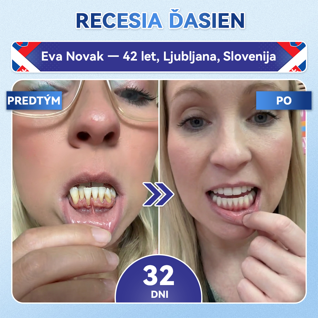 🦷𝐆𝐥𝐢𝐦𝐦𝐞𝐫𝐥𝐲® Tideglusib zuby a dasna Opravná náplasť s mikroihlami  | Pokročilé zubné pásiky s aktiváciou kmeňových buniek (obnova skloviny a dentínu • posilnenie ďasien • odstránenie zubného kameňa a zápachu • zastavenie citlivosti zubov)) 🎁