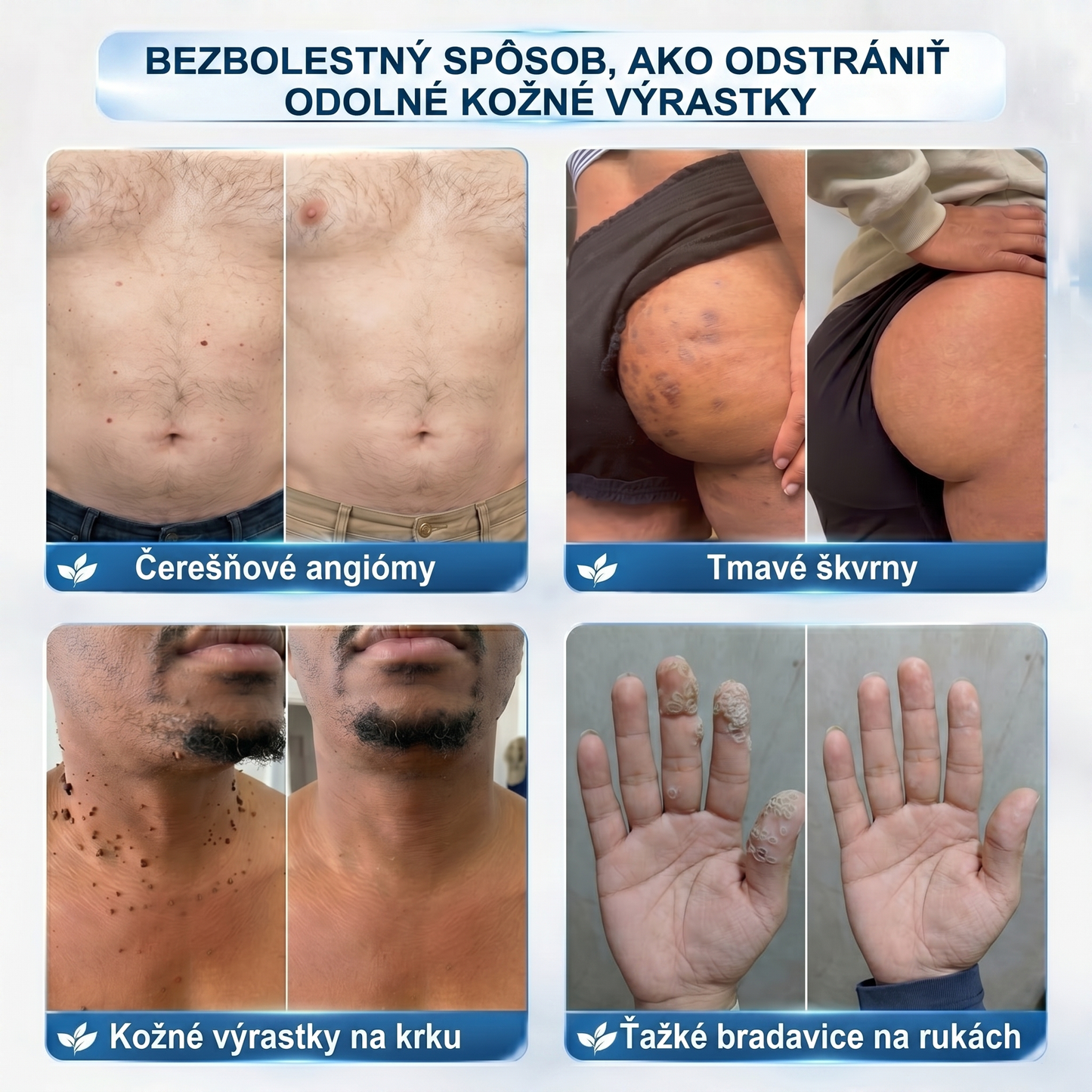 𝐏i𝐜𝐝o®💐 𝟕-𝐝ñ𝐨𝐯𝐲 𝐨𝐝𝐬𝐭𝐫𝐚ñ𝐨𝐯𝐚č 𝐤𝐨ž𝐧ý𝐜𝐡 𝐯ý𝐫𝐚𝐬𝐭𝐤𝐨𝐯 𝐚 š𝐤𝐯𝐫𝐧(Žiadna bolesť, nula rollerballov)🌹