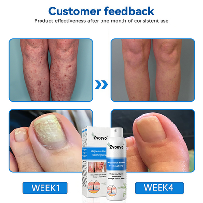 Oficiálny obchod: Zvoevo® 👩‍⚕️ Horčíkový bylinný sprej proti psoriáze — Schválené FDA (Uľavuje od psoriázy a ekzému, zlepšuje bakteriálne infekcie v genitálnej oblasti, lieči rosaceu a hidradenitídu suppurativu, ako aj akné a bradavice) 🔥